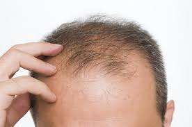 Hair Fall And Baldness Treatment Course