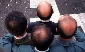 Genetic Baldness Treatment Course