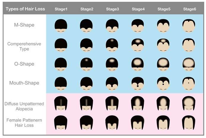 About All Hair Fall Pattern Detailed Course